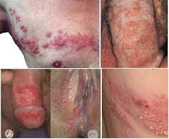 Illustration for article titled cara menghilangkan nyeri akibat herpes